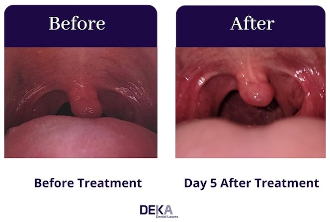 A photo showing before and after laser treatment (day 5)