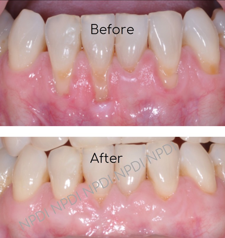 Mucogingival Deformity