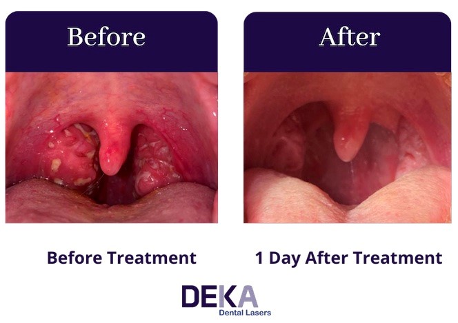 A photo showing before and after laser treatment (day 1)